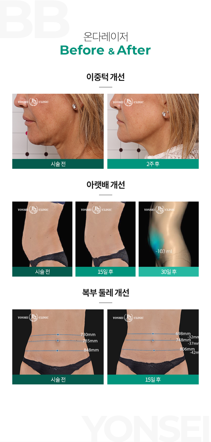 ´ٷ before&after